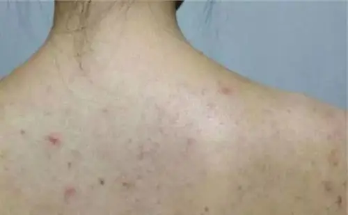 也有可能是慢性皮肤病造成的,通常被唤做脂溢性皮炎,严重的话可能