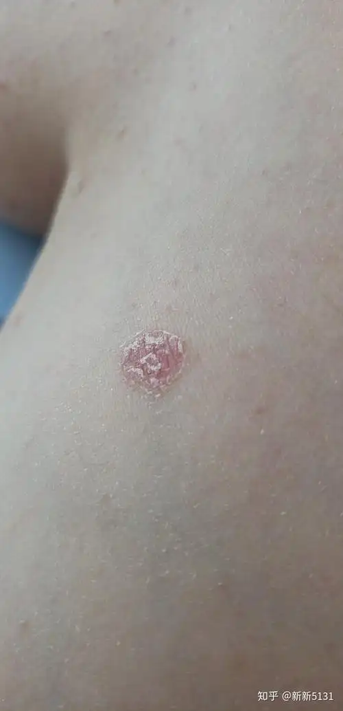 点滴型银屑病怎么破?