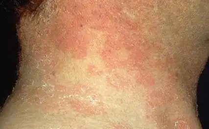 你身上出现的皮疹是银皮肤癣还是别的什么?鉴别银皮肤癣诊断方法