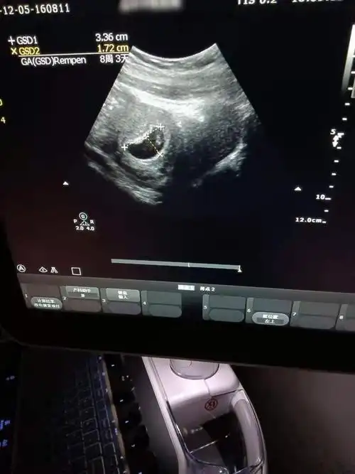 6 5查的胎心胎芽,孕囊偏大两周,孩子偏大一周,愿我的小宝贝健康平安
