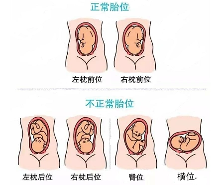 胎位不正怎么办神奇艾灸来帮您