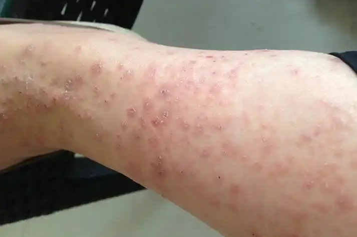 吃药过敏图片_有来医生