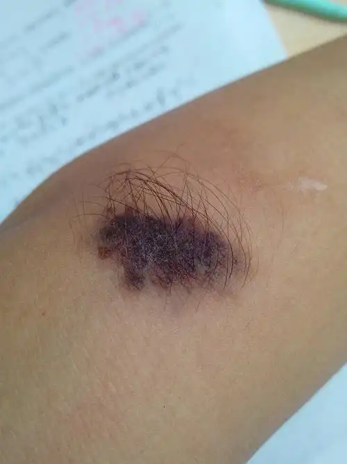 我现在17岁,黑毛痣长大了,然后中间,就像冬天太干燥的时候的样子,这是