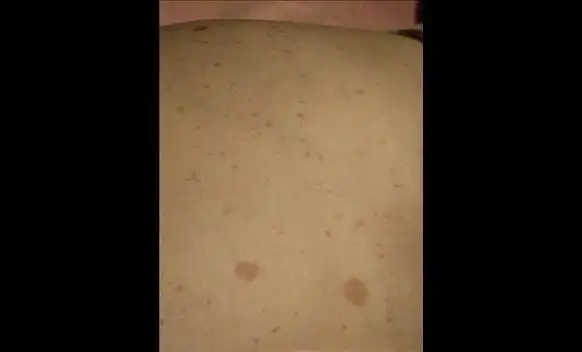 中药可以治疗咖啡斑吗