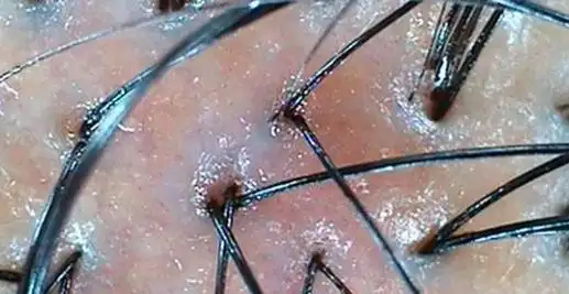 头皮潮红色,毛孔口,发根部有蜡状物包裹,甚至出现毛囊炎毛囊萎缩严重