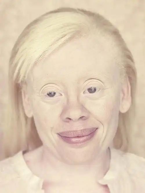 获奖无数!摄影师带你走进白化病人