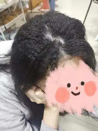 这个头顶摩根烫是不是烫坏了,太惨了!