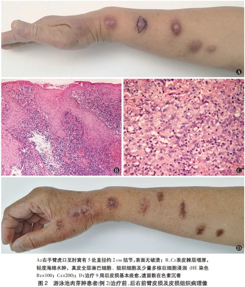 游泳池肉芽肿是由海鱼分枝杆菌直接接种感染引起的慢性皮肤肉芽肿