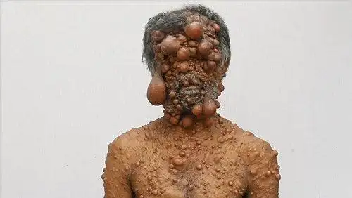 奇葩怪病致他浑身肉瘤!五官已不可辨认!