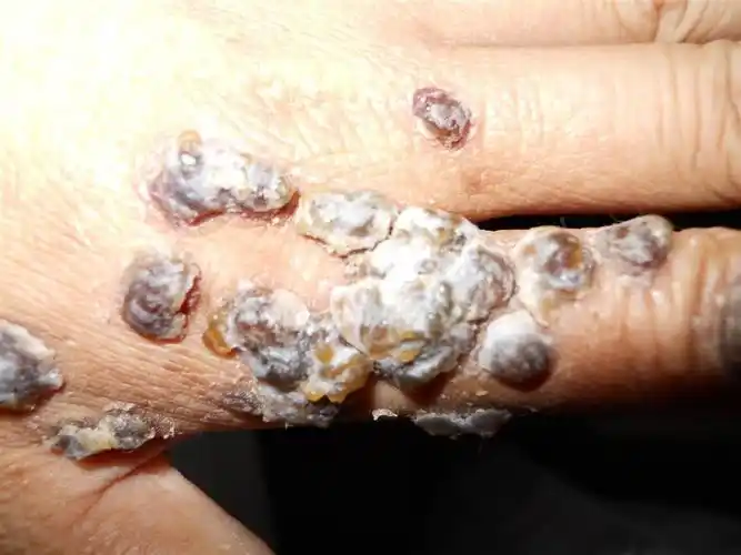 皮肤及性传播疾病讨论版 - 爱爱医医学论坛 - 爱爱医医学网