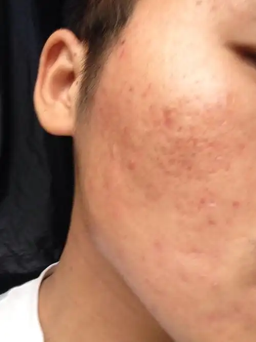 我这个为什么会红红的,角质层是薄还是厚,怎么看的,这个痘印严重吗,这