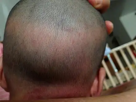 妈妈们 佝偻病是怎么样的?