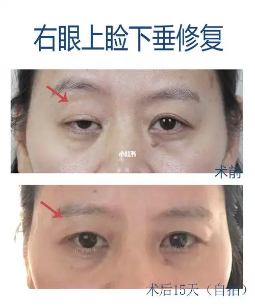 右眼上睑下垂修复_郑州自由行热门攻略_郑州_上睑下垂_美妆_医美整形