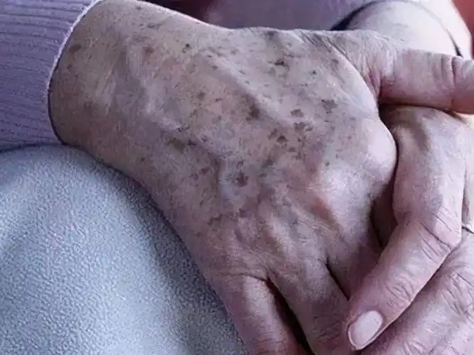 面部色斑怎么判断脸上是什么斑