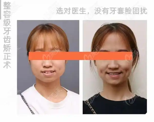牙齿矫正脸型前后对比