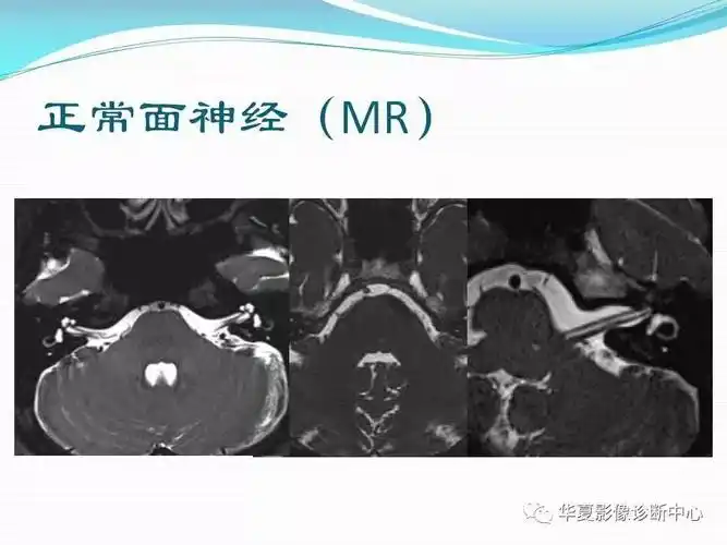 面神经解剖及常见病变影像诊断
