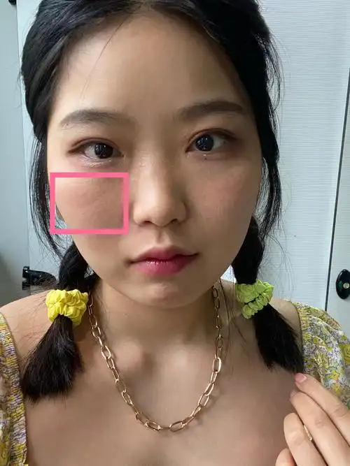 颧骨下方笑起来有一条凹陷的坑