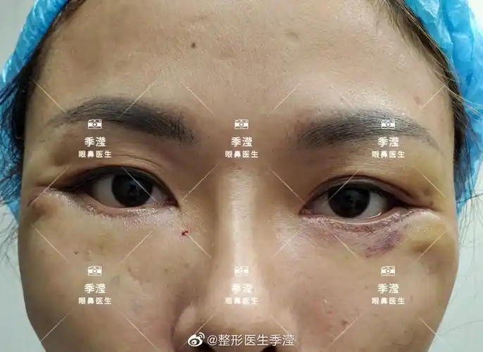 术后十天,但是发现下眼睑退缩已经开始,她有些后悔第一次手术没有听我