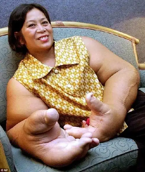 泰女子患罕见巨臂症持近20公斤巨手痛苦59年