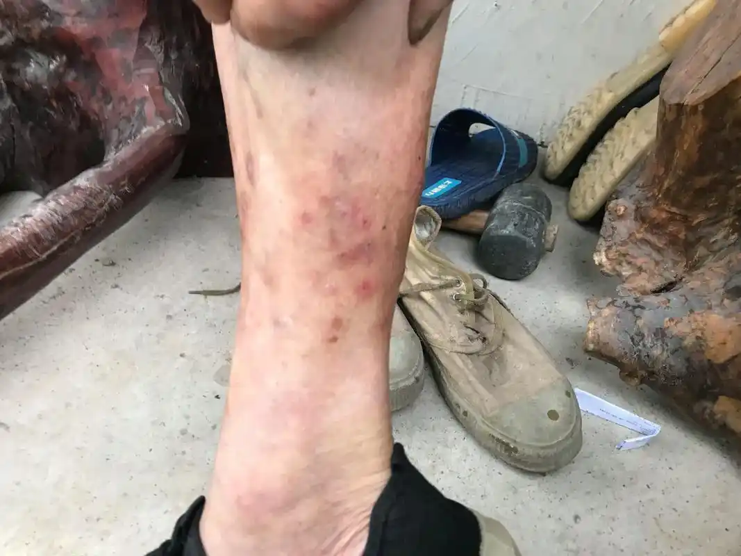 求问哪里能看这样的皮肤病就小腿上反复长痒抓了有血