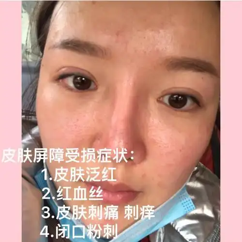 皮肤屏障受损让肌肤修养生息辅助用医学护肤品