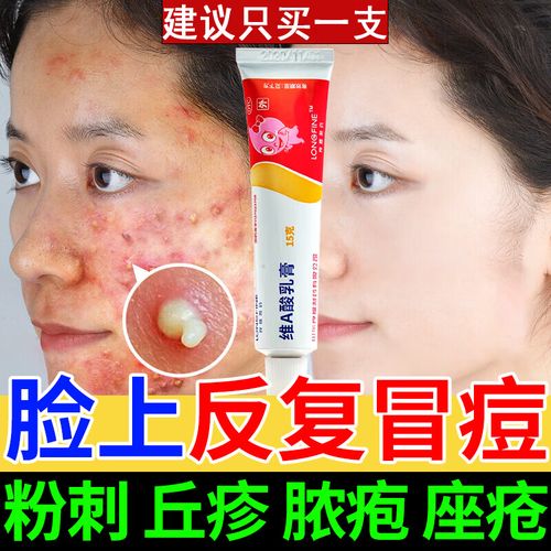 痘痘的药 痤疮膏 脓疱疮去粉刺痘痘药膏 脸上长痘痘皮肤用药非处方药