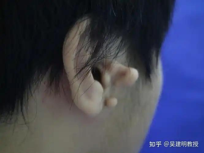 有哪些常见的耳廓形态畸形类型该如何去分辨
