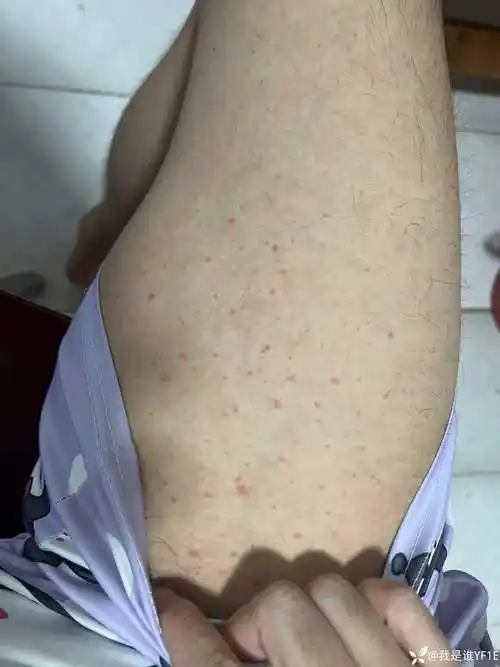 过敏性皮炎真菌感染