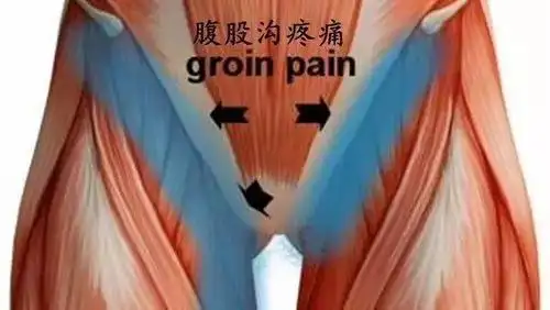 男人当你大腿根,腹股沟疼痛时,你需要注意这3种疾病!