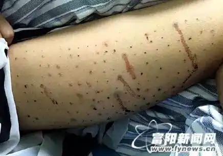 80后妙龄姑娘的腿上为什么有100多个窟窿密集恐惧症者勿入