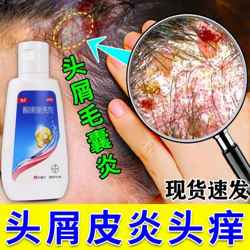 康王 酮康唑洗剂 头皮屑去屑药 去屑洗发水 头皮痒脂溢性皮炎  头皮