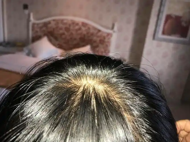 这样的发根是不是已经属于脱发的现象?或者已经没救了,最近比较脱发