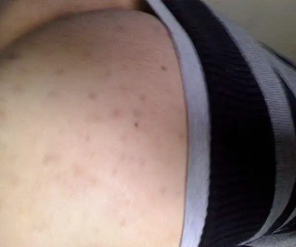 女性艾滋病皮肤症状