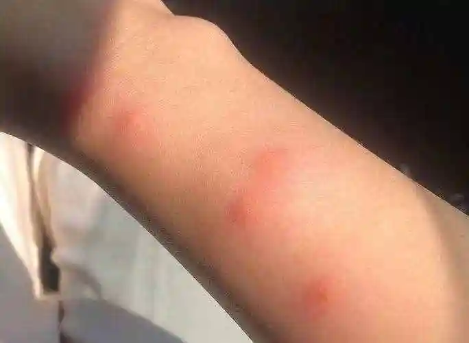 丘疹性荨麻疹又叫虫咬皮炎,一般由蚊子,臭虫,虱子,螨虫,蠓等蚊虫叮咬