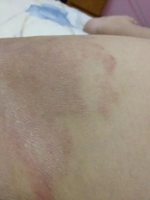 大腿内侧靠近阴部长了好多红色疙瘩很痒,抓了后颜色变暗,请问这是什么