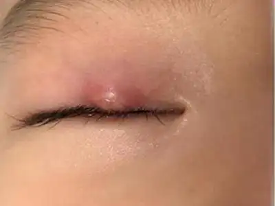 可表现为患儿上眼睑出现疙瘩,约黄豆大小,凸起于眼皮周围皮肤,疙瘩