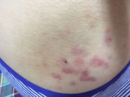 问:屁股这里突然起了好多红疙瘩,不疼不痒,这是怎么回事?求助?