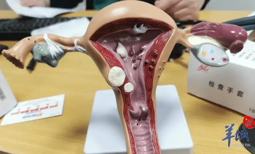 生完孩子痛经就能改善?别再傻傻地相信了_子宫