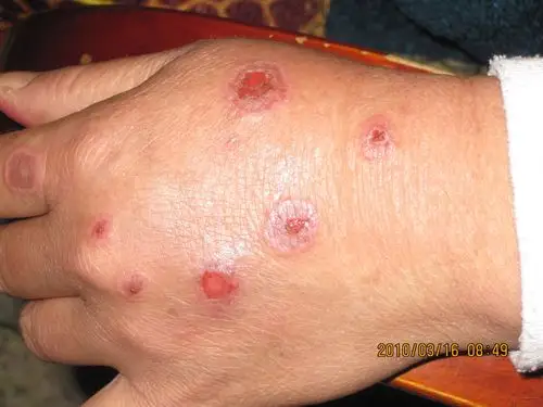 看图识病 - 皮肤及性传播疾病讨论版 - 爱爱医医学论坛