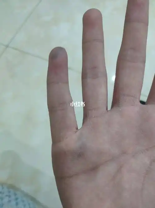大鱼际青经明显,整个手掌发青手上突然之间出现淤青是怎么回事?