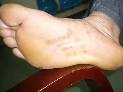 典型病例——二期梅毒