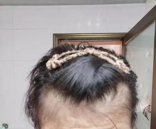 想问问集美们这种m秃还有救吗555