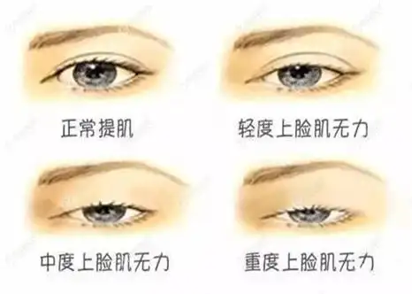 眼睛提肌无力图片