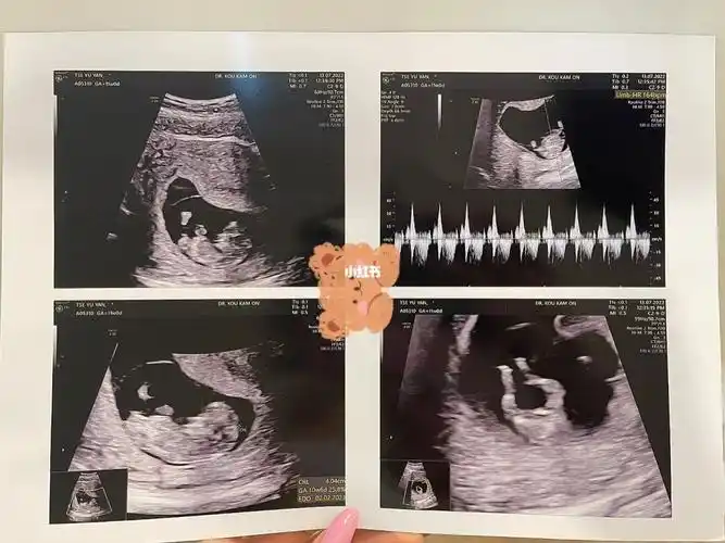 孕11周宝宝真的会动耶生命好神奇