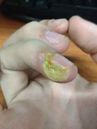 手指头 本来是有点长起东西来一样 然后没去管他 然后又去把坏的肉剪