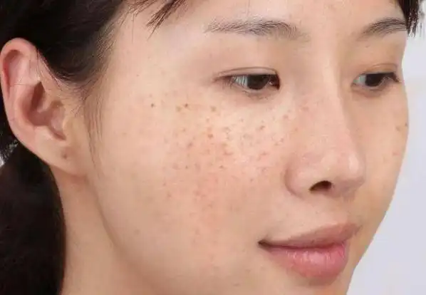 女性常吃白菜会加重面部斑点?医生:不想长斑,4种蔬菜或要少吃