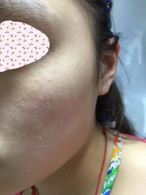 我才21,皮肤超级粗糙暗黄毛孔粗大有木有!