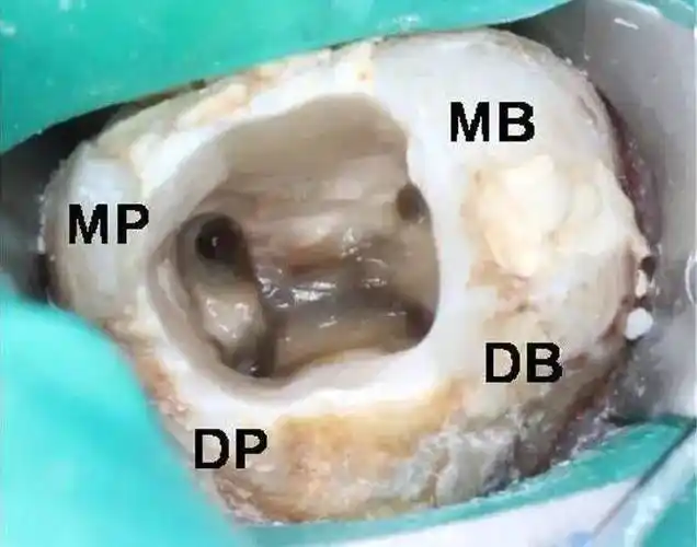 ①根管口对称法则:根管口对称分布于通过髓室底近,远中中点的连线两侧