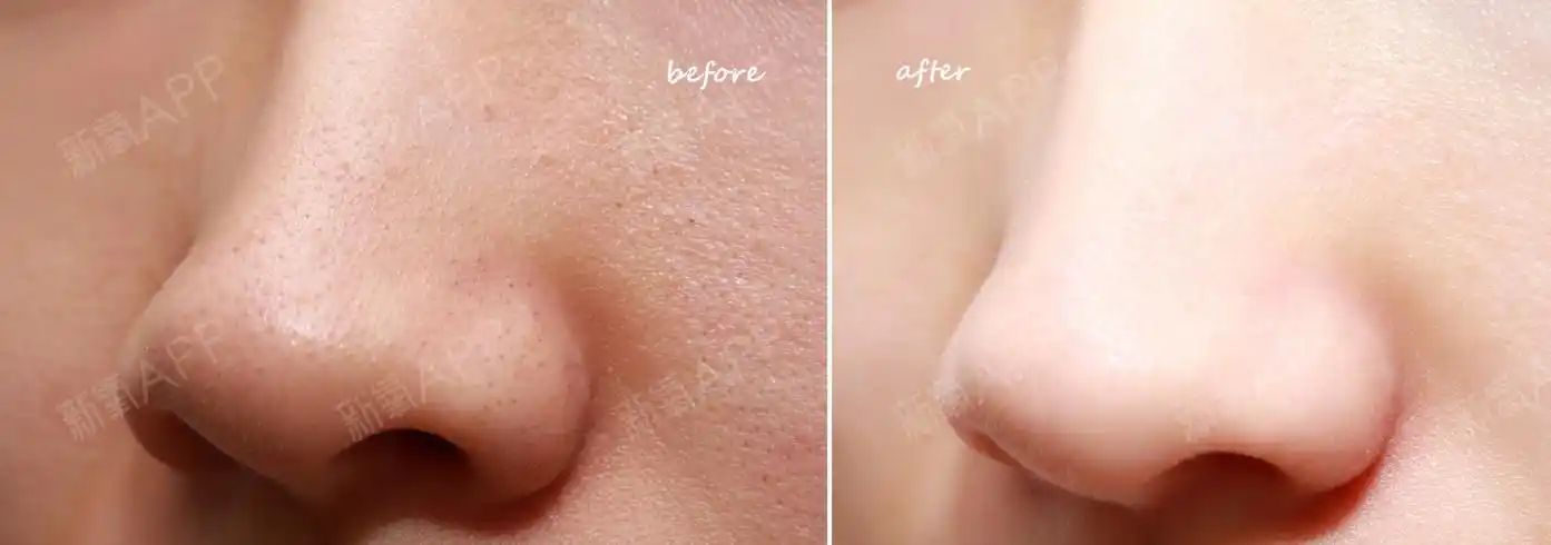 收缩毛孔是激光好还是微针好