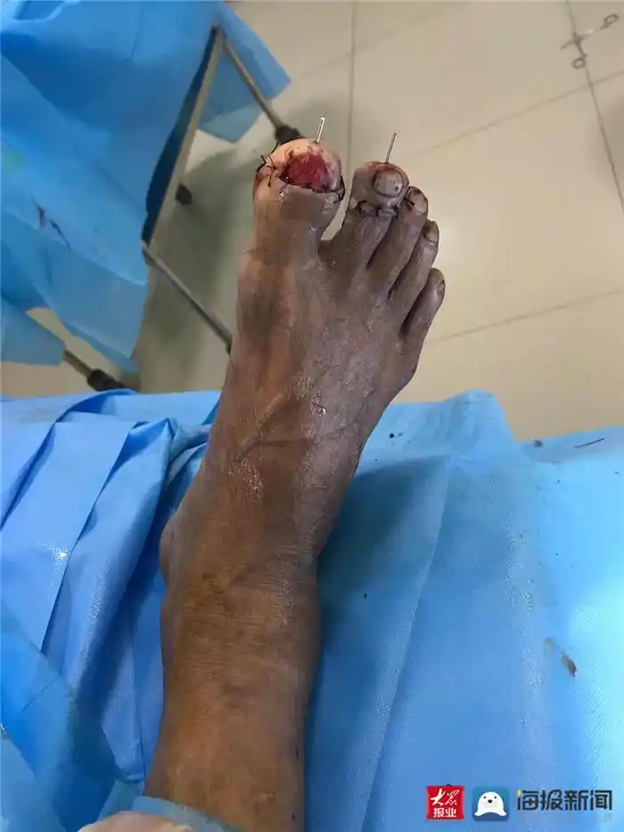 六旬老伯误锯掉2根脚趾泰安市中心医院分院骨科妙手回春接断趾